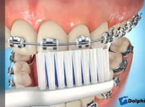 Brossages des dents avec  des brackets